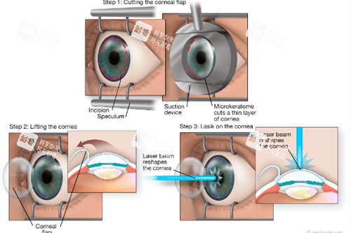 近視手術(shù)操作過程圖解