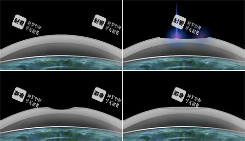 smart激光近視手術(shù)過程