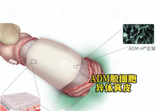 陰莖生物補片ADM材料是什么