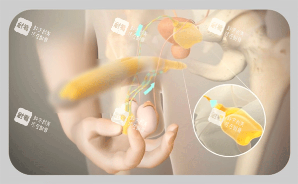 男性陰莖假體植入三件套手術(shù)過程