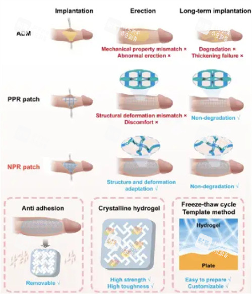 陰莖生物補片手術(shù)過程