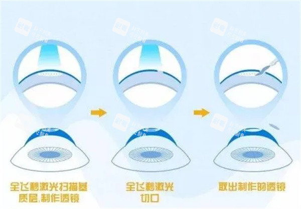 全飛秒激光眼睛照片