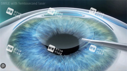全飛秒手術演示圖