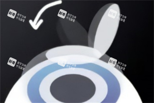 半飛秒蓋回角膜瓣 半飛秒蓋回角膜瓣