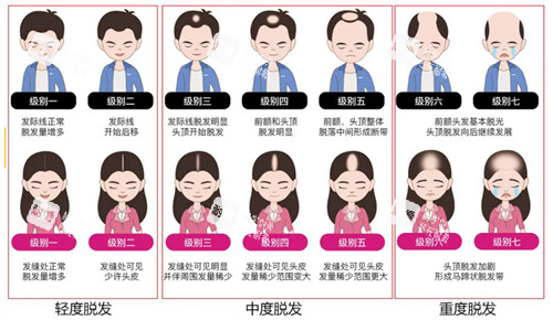 不同程度的脂溢性脫發(fā)
