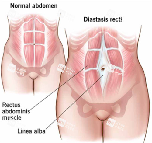腹壁成形手術(shù)前后對(duì)比圖一覽