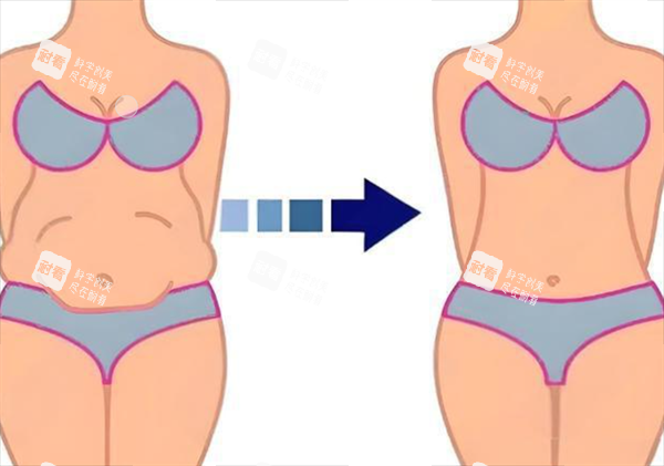 腹壁成形術(shù)