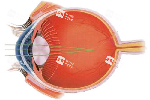 近視光線示意圖