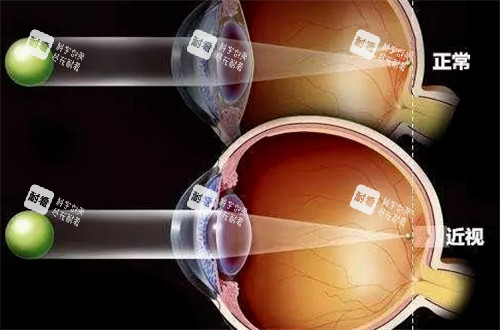 正常視力和近視視力表現(xiàn)圖