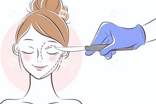 雙眼皮手術(shù)設(shè)計