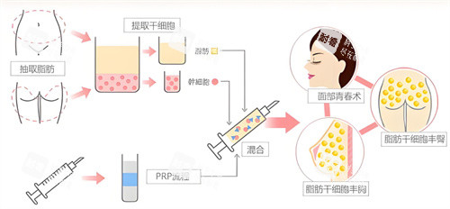 自體脂肪隆胸過程