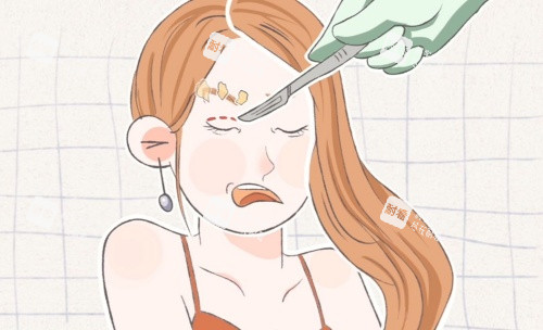 拉雙眼皮示意圖