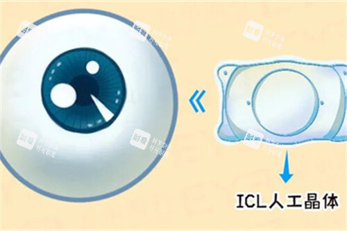 icl人工晶體與眼球漫畫圖