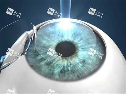 人工晶體植入眼睛圖示