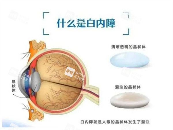 什么是白內(nèi)障