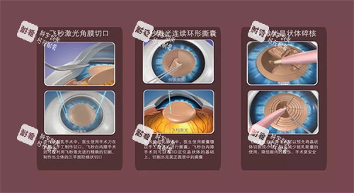 飛秒白內(nèi)障手術(shù)流程