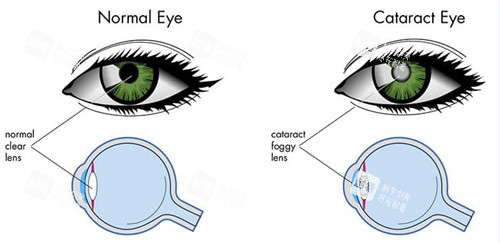 正常眼睛和白內障眼睛晶體區(qū)別