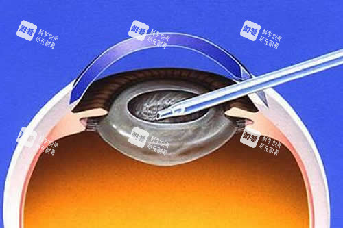 白內障手術卡通圖