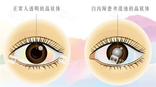 白內障和正常眼球的對比圖