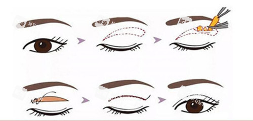 全切雙眼皮過程示意圖