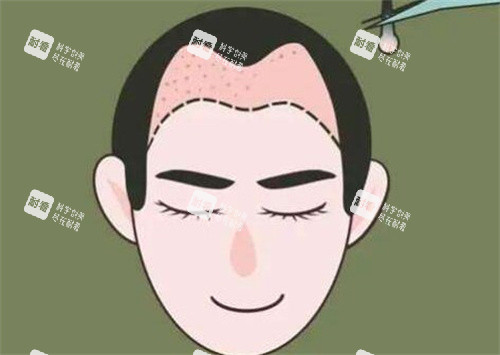 M型發(fā)際線種植