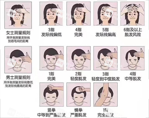 發(fā)際線測量規(guī)范