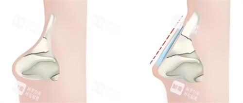 隆鼻超肋材料對比