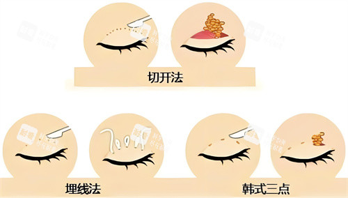 雙眼皮方法對比圖