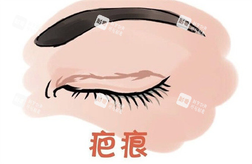 雙眼皮術后疤痕