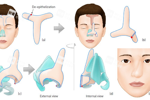 鼻再造手術(shù)過程