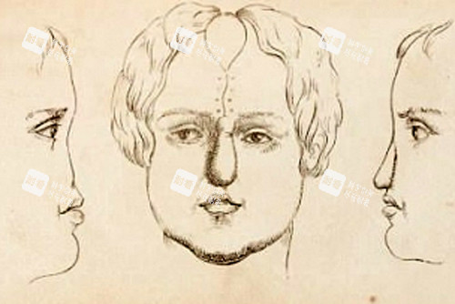 鼻再造術(shù)后