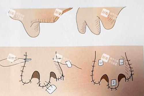 鼻再造術(shù)后變化