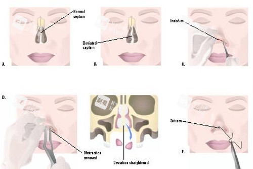 鼻再造手術(shù)的過程圖解