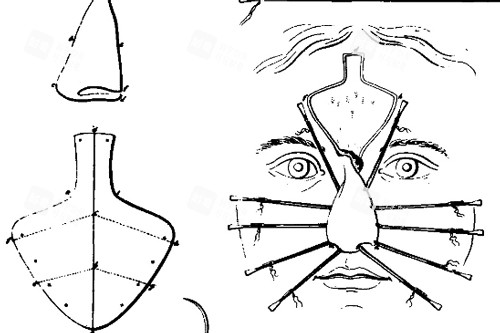 鼻再造手術(shù)部位