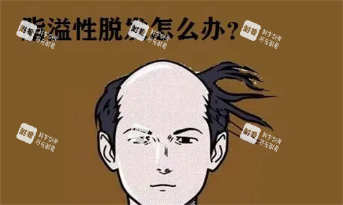 脂溢性脫發(fā)怎么辦
