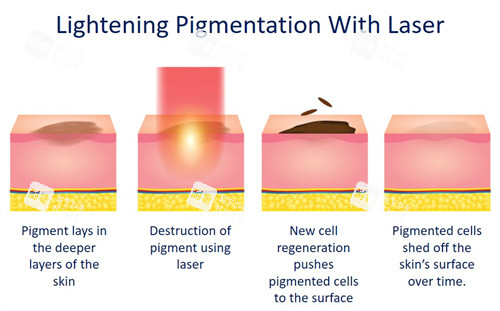 激光祛斑如何改善皮膚斑點