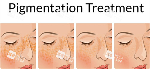 激光祛斑前后皮膚對比