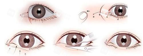 開眼角手術(shù)方法