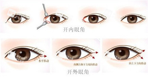 開眼角手術(shù)過程圖