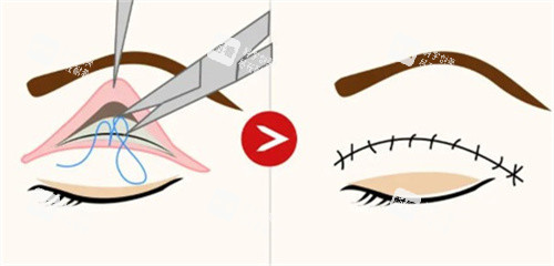 埋線雙眼皮過程