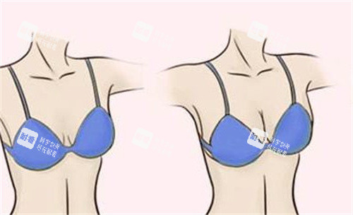 隆胸效果對比 隆胸效果對比