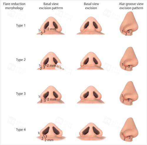 不同鼻子縮小鼻翼對比圖