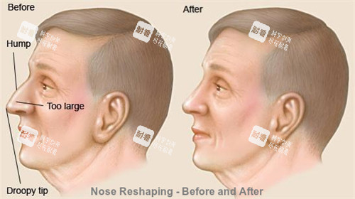 正常鼻子和過長的鼻子矯正對比