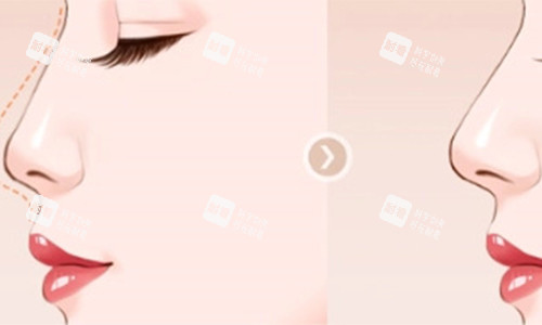 墊鼻子的前后對比動畫圖