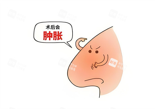 隆鼻術(shù)后腫脹動畫圖