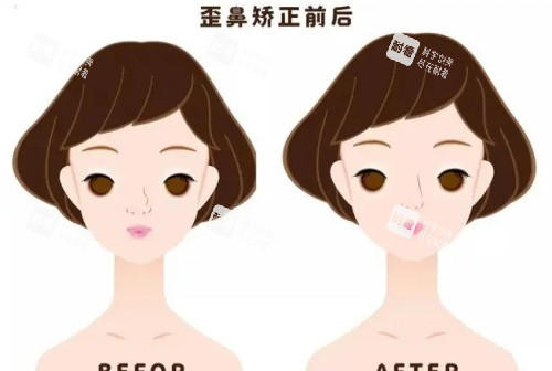 假體鼻子歪斜矯正前后示意圖