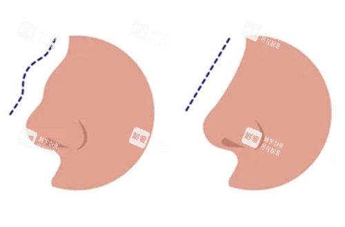 修復(fù)失敗鼻子前后對(duì)比圖