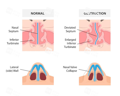 扭曲鼻子的修復(fù)對(duì)比圖