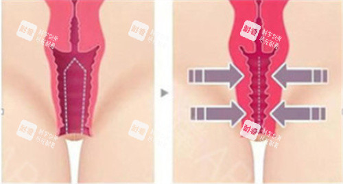 私密緊縮手術(shù)前后對(duì)比差異