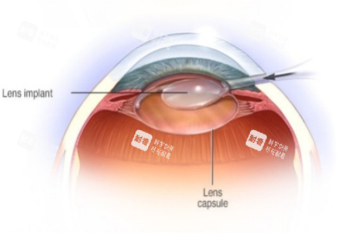 白內障晶體放入示意圖